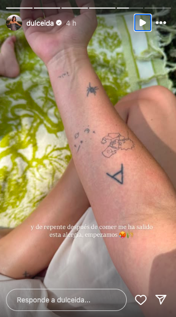 Dulceida y su alergia han preocupado a sus millones de fans en Instagram